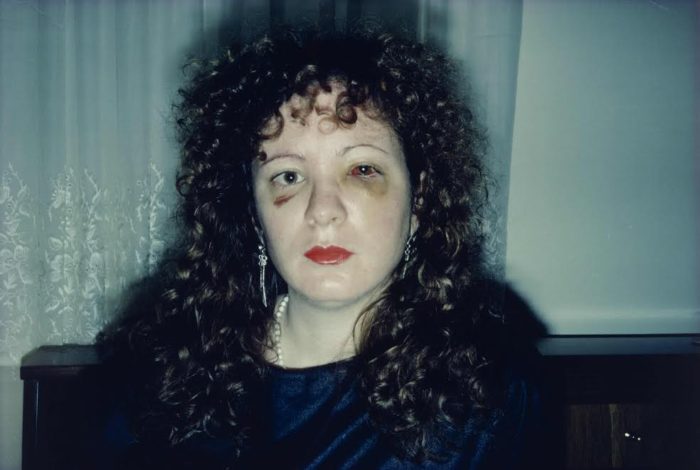 Nan One Month After Being Battered, 1984 